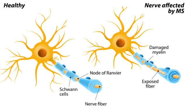 Multiple Sclerosis (MS)